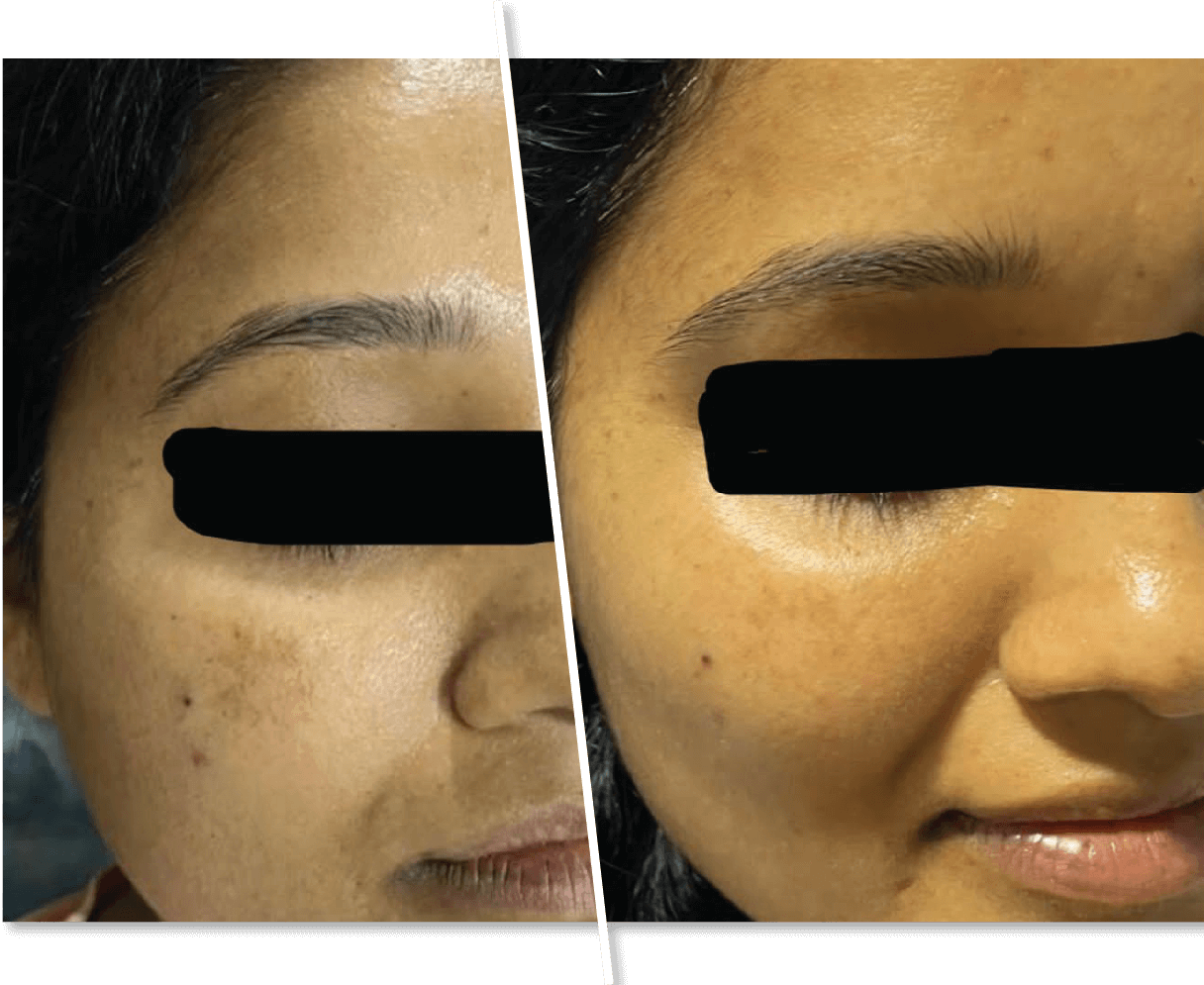 Lady Before and After Acne Treatment